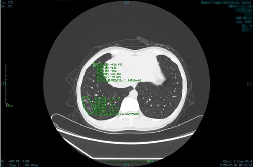 Ping An screening system identifies 1,600 coronavirus cases